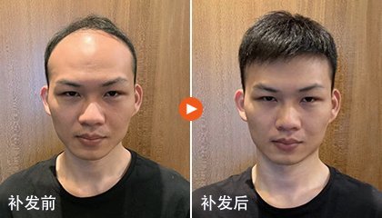 梦见秃顶(梦见秃顶是什么征兆 男人)